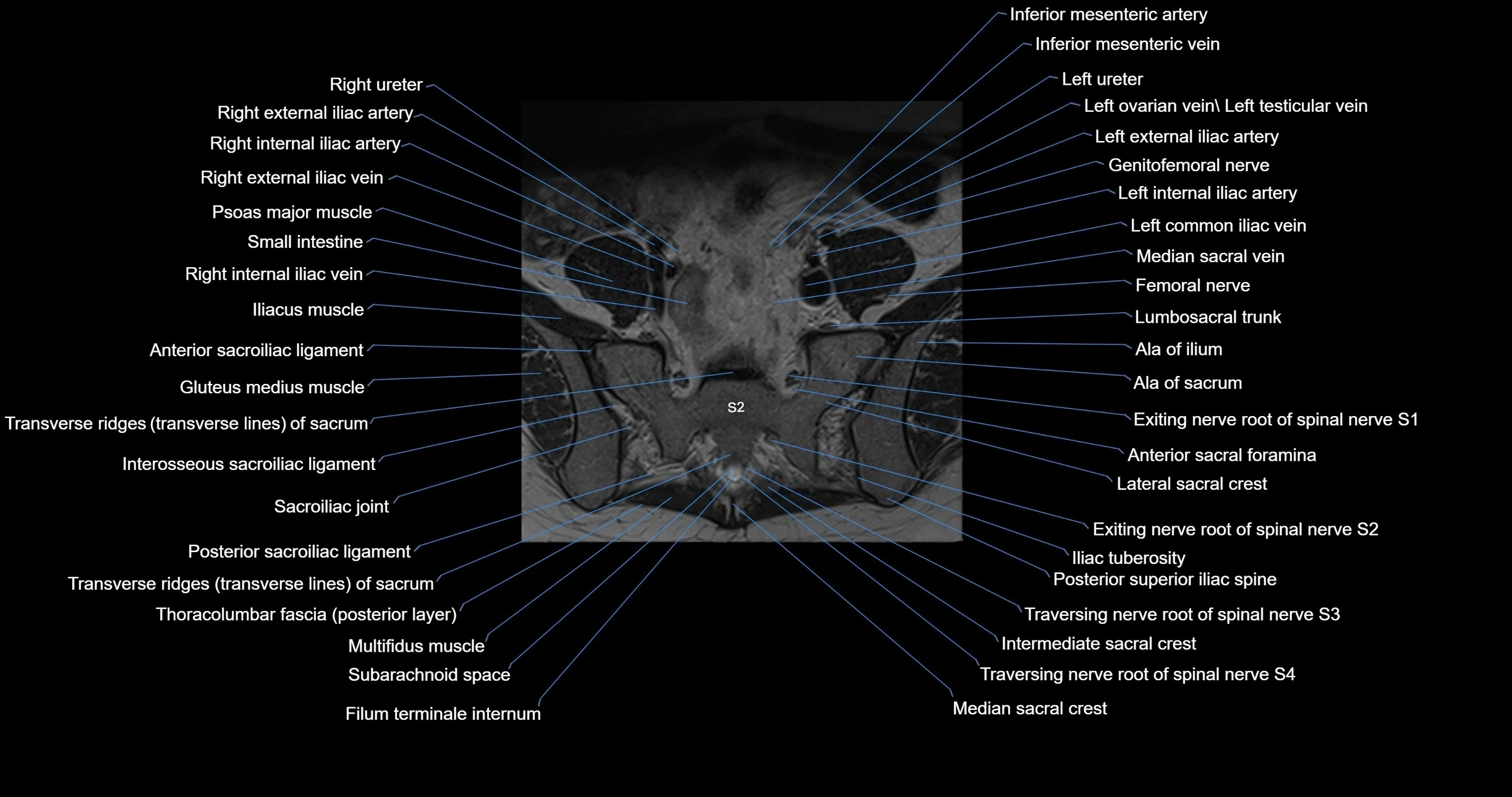 MRI lumbar spine axial cross sectional anatomy 3T radiology  image-img-00001-00048.webp